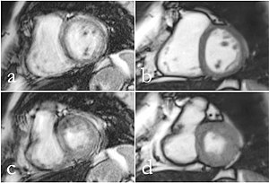 (a,c) CINE and (b,d) RT CMR at 1.5 T of a patient with atrial fibrillation in a mid-ventricular SA view during end-diastole (a,b) and end-systole (c,d). CINE mages have reduced diagnostic quality (score 1), while RT images present with good diagnostic quality. CMR Cardiac.jpg