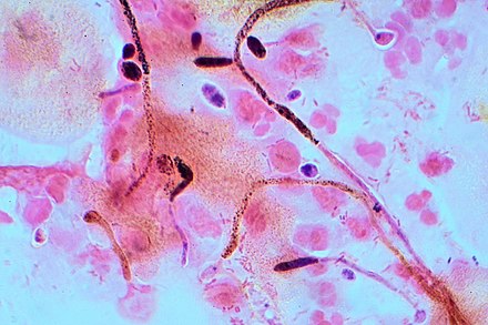 Gram stain of Candida albicans from a vaginal swab. The small oval chlamydospores are 2–4 µm in diameter.