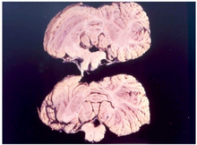 Cerebellum of a kuru patient Cerebellum of kuru victim.png