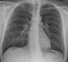 Chest X-ray of sarcoidosis nodules.png