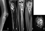 Thumbnail for Aneurysmal bone cyst