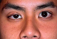 Congenitalptosis.JPG