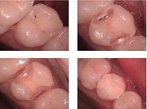 Dental Restoration