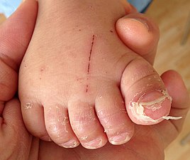 Peeling of toes