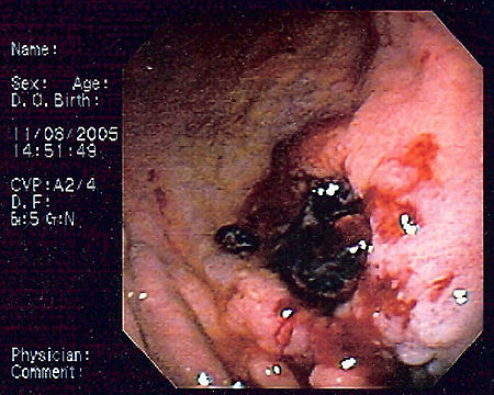 صورة بالتنظير الداخلي للمفوما النسيج الليمفاوي المرتبط بالغشاء المخاطي (المخاطية) مأخوذ من جسم المعدة لدى مريض مصاب بنزيف الجهاز الهضمي العلوي. المظهر شبيه بقرحة المعدة مع خثرة ملتصقة.