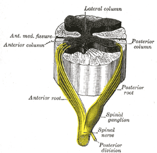 <span class="mw-page-title-main">Sensory neuronopathy</span> Sensory neuropathy caused by damage of nerve cells in the dorsal root ganglion