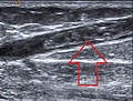 A superficial vein thrombosis in the great saphenous vein.