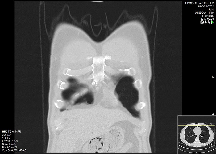 High-resolution computed tomograph of a normal thorax, coronal plane (4).jpg