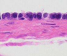 On histopathology, paraovarian cysts are generally lined by simple cuboidal epithelium as shown. However, they may have fallopian tubal epithelium or focal papillary projections. Histopathology of paratubal cyst.jpg