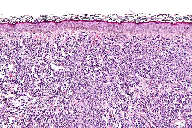 File:Mastocytosis - high mag.jpg