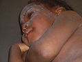 Measles in African Child 4.JPG