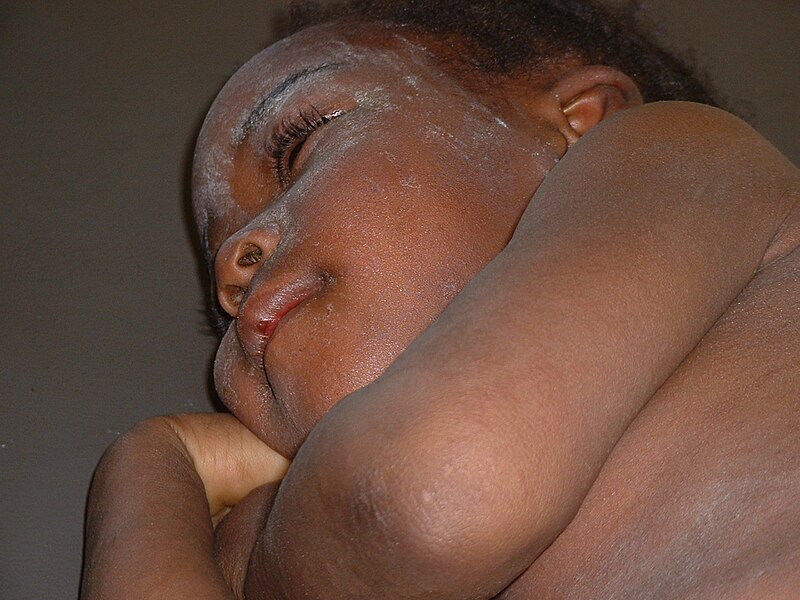 File:Measles in African Child 4.JPG