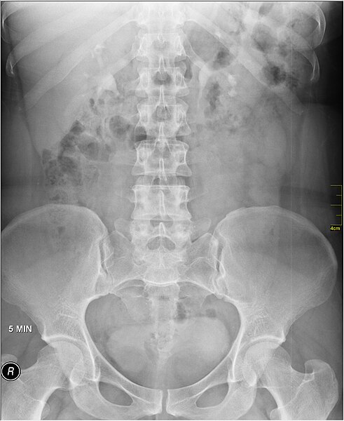 File:Medical X-Ray imaging PNX06 nevit.jpg