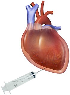 Pericardiocentesis Procedure where fluid is aspirated from the pericardium