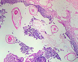 Pinworms in the Appendix (1).jpg