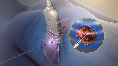 Radiofrequency ablation.jpg