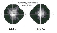 Visual field-tubular vision Retinitis Pigmentosa visual field.tif