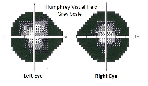 קובץ:Retinitis Pigmentosa visual field.tif