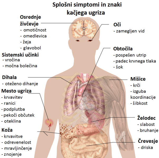 File:Simptomi in znaki kačjega ugriza.png