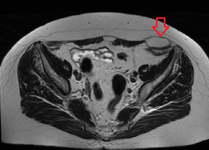 Spieghel-hernia MRI.png