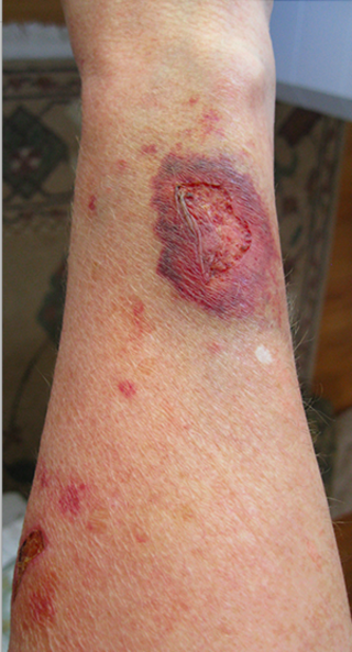 <span class="mw-page-title-main">Steroid-induced skin atrophy</span> Medical condition