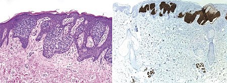 Comparison H&E stain (left) with BerEP4 immunohistochemistry staining (right) on superficial BCC pathological sections mimicking Bowen's Disease. At bottom, columnar epithelium in normal sweat glands stain positive too. Superficial BCC with HE and BerEP4.jpg
