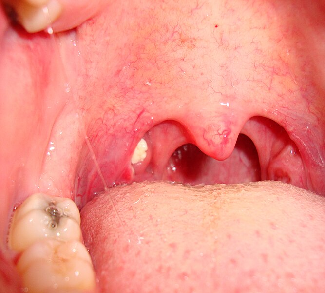 File:Tonsilloliths 20091119 prior to tonsillectomy.JPG