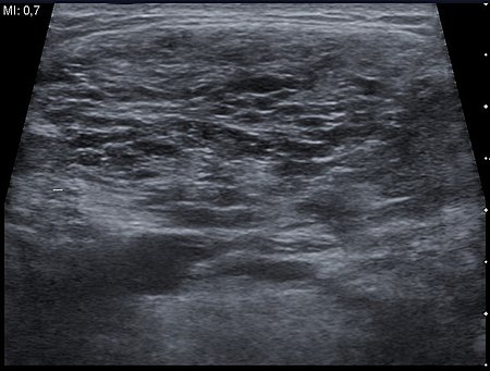Ultrasound image Cystic Hygroma 20170957156 17F.jpg