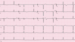 تخطيط كهربائية القلب of Wellens' syndrome. Note biphasic T-waves in leads V1-V4.