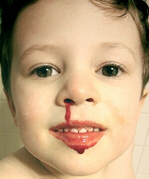 Jeune enfant avec saignement de nez, souriant cropped.jpg