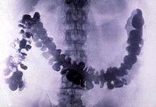 Amoebiasis as seen in a radiograph of a barium-filled colon BariumXray.jpg