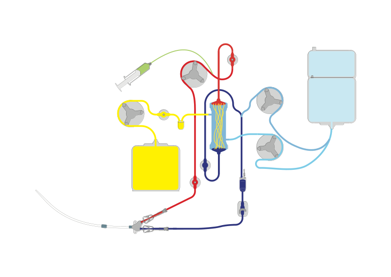 File:Continuous Venon Venous HaemoDIALAfiltration (CVVHDF).svg