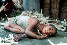 Severely disabled girl in Bhutan Cretin Child (1).jpg