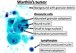 Thumbnail for Warthin's tumor