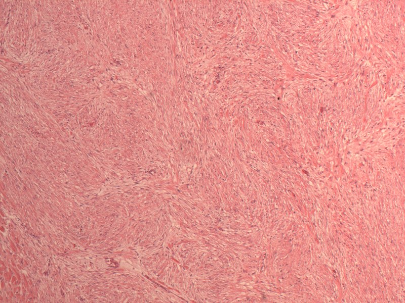 File:DesmoidFibromatosis.TIF