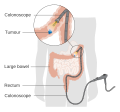 Diagram showing a local resection of an early stage bowel cancer