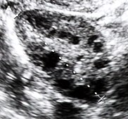 Ultrasound of a polycystic ovary. Each of the dark circles represents a fluid-filled cyst. Echographie pelvienne, aplio toshiba ssa 700 5 2004 03 detail.jpg