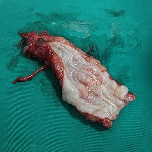 Esophageal cancer specimen.jpg