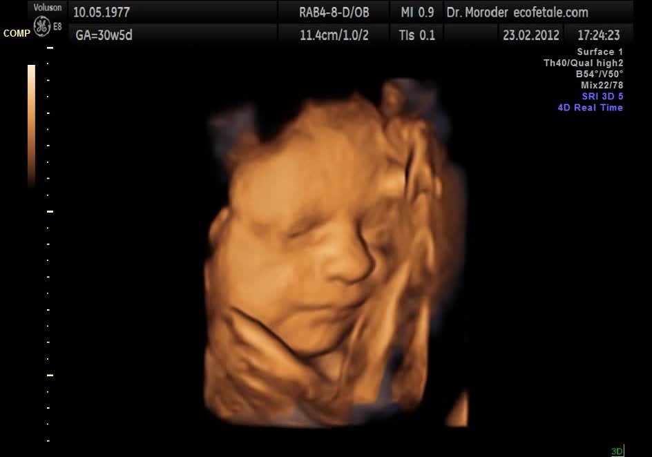 File Fetal Yawning 4d Ultrasound Ecografia 4d Dr Wolfgang Moroder Theora Ogv Wikipedia