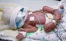 Premature infant in an incubator at the Mcmaster Children's Hospital NICU Mcmaster premie NICU 7045.jpg
