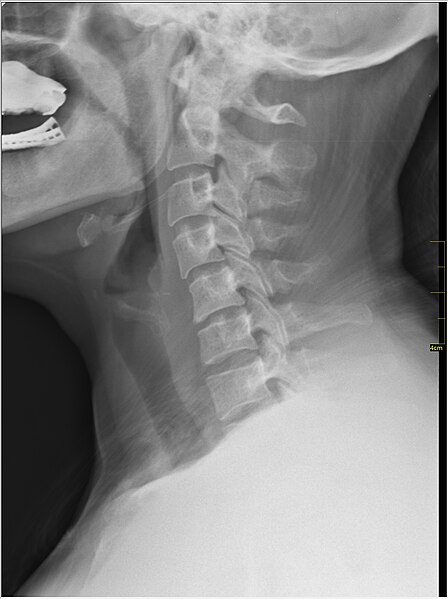 File:Medical X-Ray imaging SID07 nevit.jpg