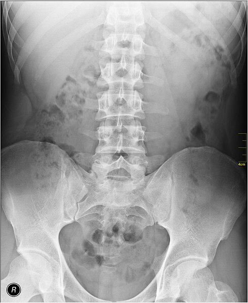 File:Medical X-Ray imaging SJH07 nevit.jpg