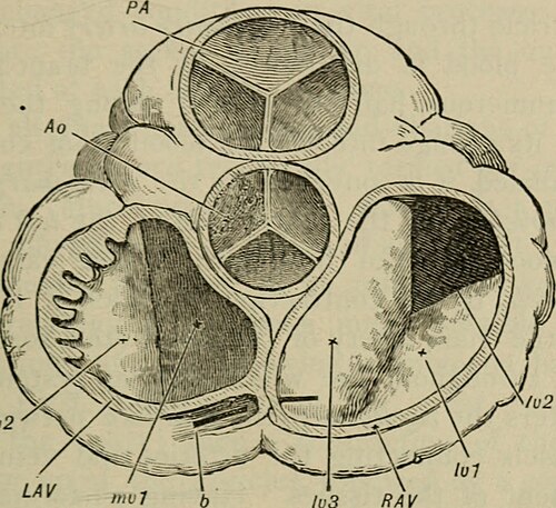 Valve arrangement showing aortic valve ("Ao") posterior to pulmonary valve ("PA")