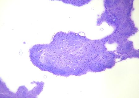 Tumor_kelenjar_perianal