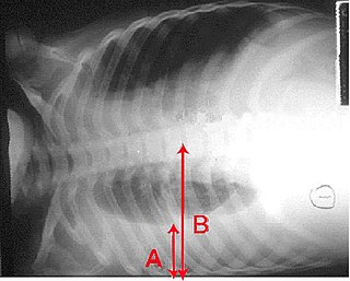 Pleural effusion