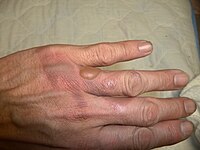 Thermal Injury in Chatama's hand.jpg
