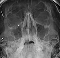 Thumbnail for Zygomaticomaxillary complex fracture