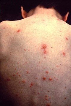 Varicella