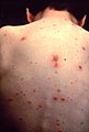 Chickenpox on a child