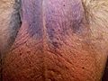 Angiokerotoma of the Scrotum - Example 3